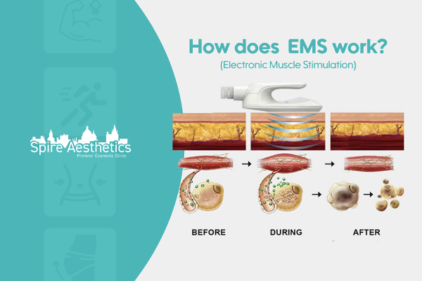EMS treatment for post pregnancy weight loss treatment Maplehurst