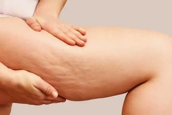Image of woman showing leg with cellulite Maplehurst