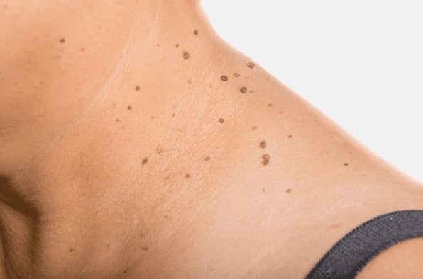 Are you looking for easy skin tag removal Maplehurst - then contact Spire today!