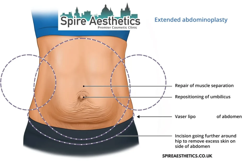 Understanding Loose Skin After Gastric Band Maplehurst Surgery and HIFU Treatment