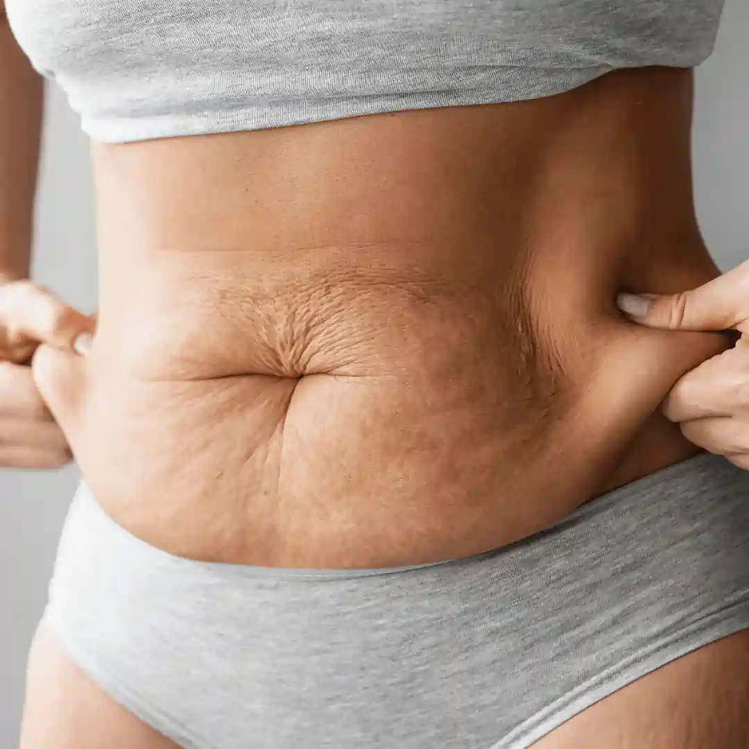 Is It Normal to Have Loose Skin After Pregnancy Maplehurst?